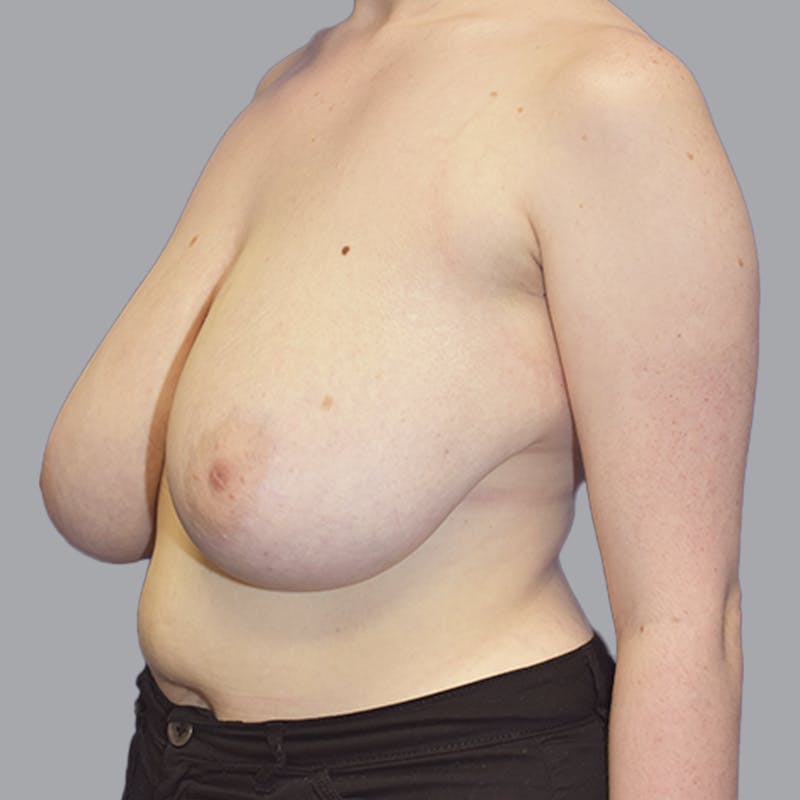 Breast Lift Before & After Gallery - Patient 408496 - Image 3