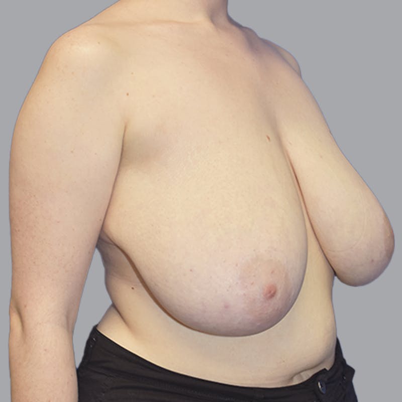 Breast Lift Before & After Gallery - Patient 408496 - Image 5