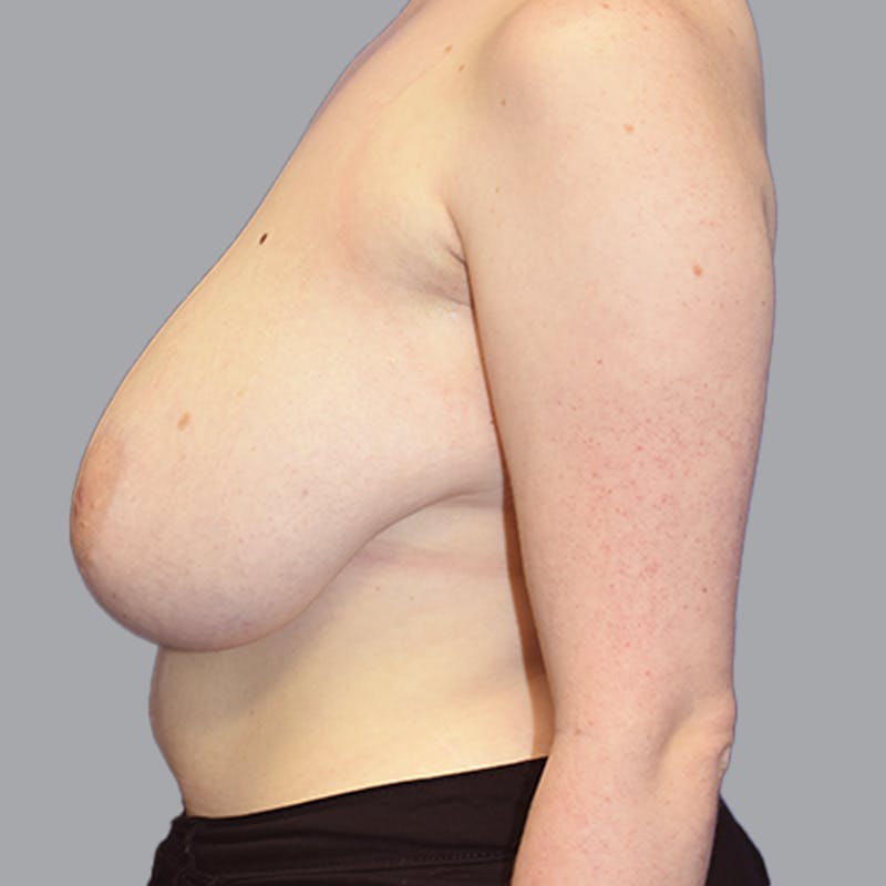 Breast Lift Before & After Gallery - Patient 408496 - Image 7