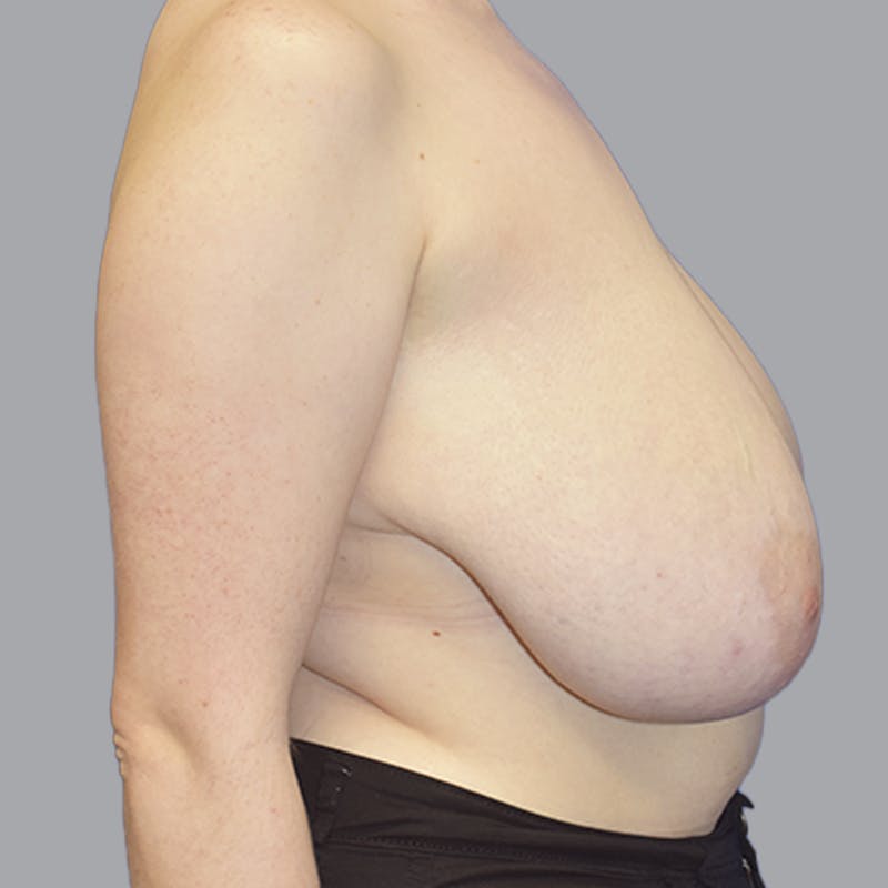 Breast Lift Before & After Gallery - Patient 408496 - Image 9