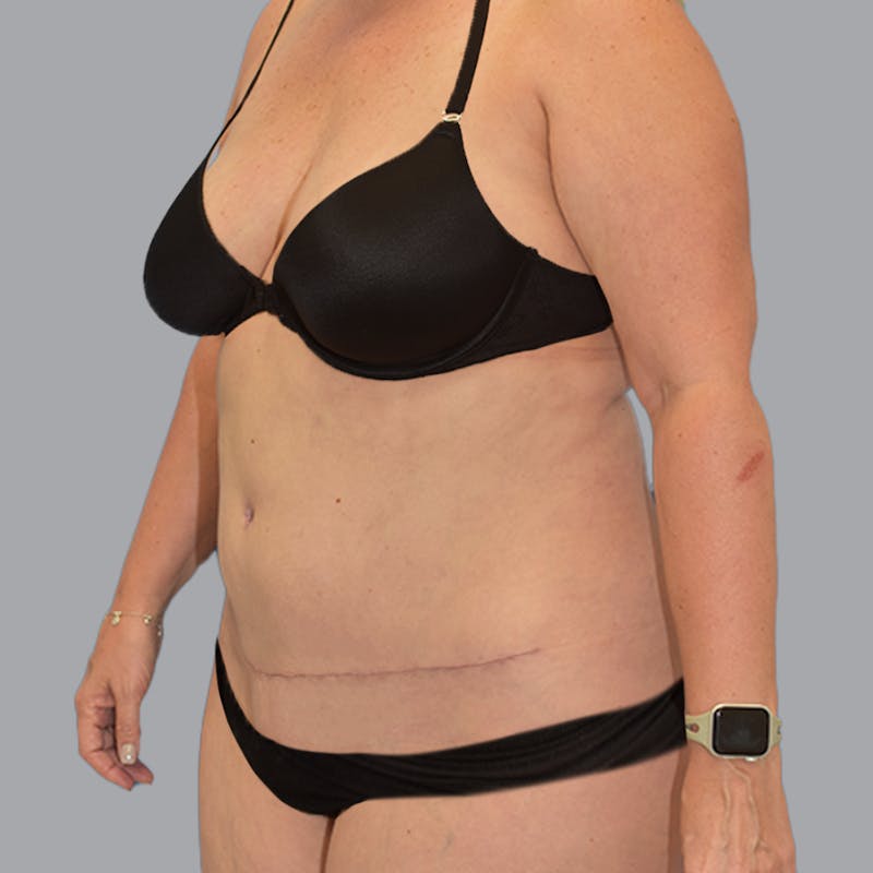 Abdominoplasty Before & After Gallery - Patient 704700 - Image 6