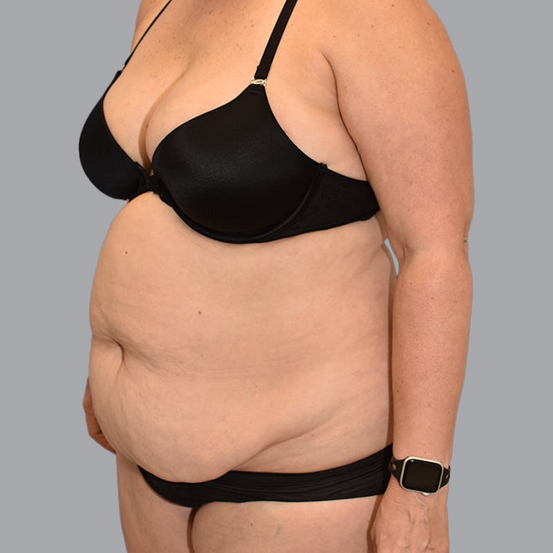 Body Liposuction Before & After Gallery - Patient 246752 - Image 5