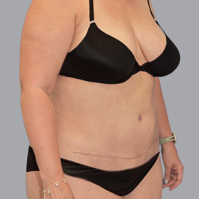 Abdominoplasty Before & After Gallery - Patient 704700 - Image 4