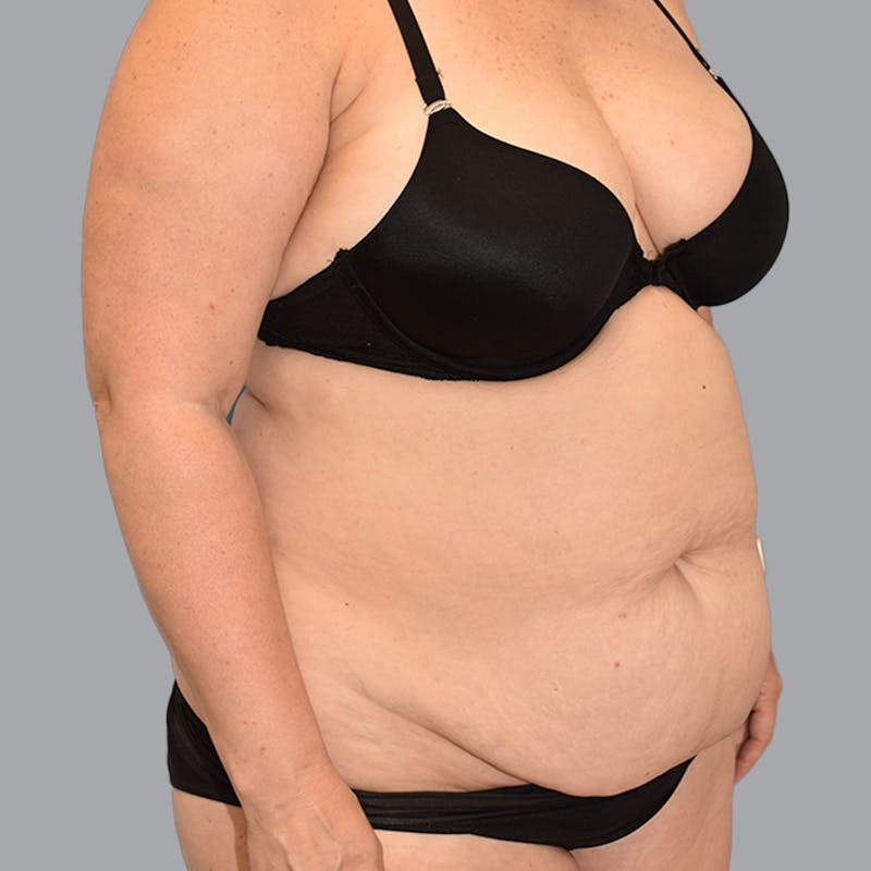 Body Liposuction Before & After Gallery - Patient 246752 - Image 3