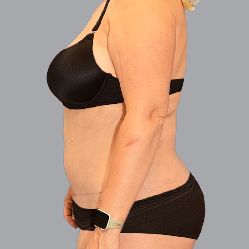 Abdominoplasty Before & After Gallery - Patient 704700 - Image 8
