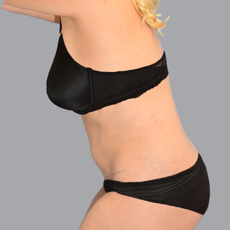 Abdominoplasty Before & After Gallery - Patient 704700 - Image 9