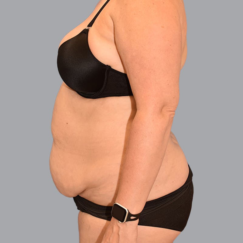 Abdominoplasty Before & After Gallery - Patient 704700 - Image 7