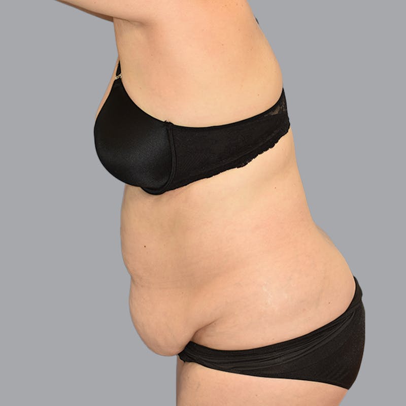 Abdominoplasty Before & After Gallery - Patient 704700 - Image 10