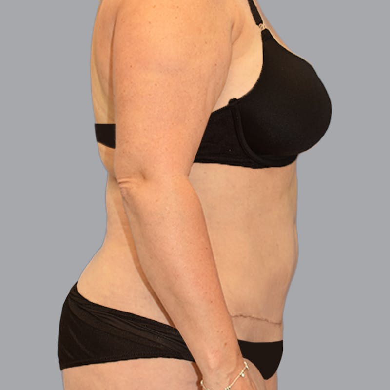 Body Liposuction Before & After Gallery - Patient 246752 - Image 11