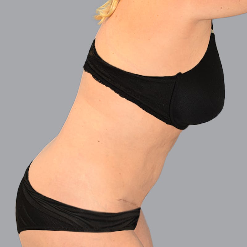 Body Liposuction Before & After Gallery - Patient 246752 - Image 12
