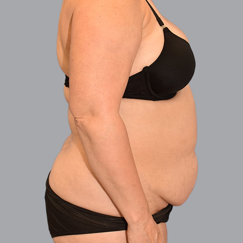 Abdominoplasty Before & After Gallery - Patient 704700 - Image 14