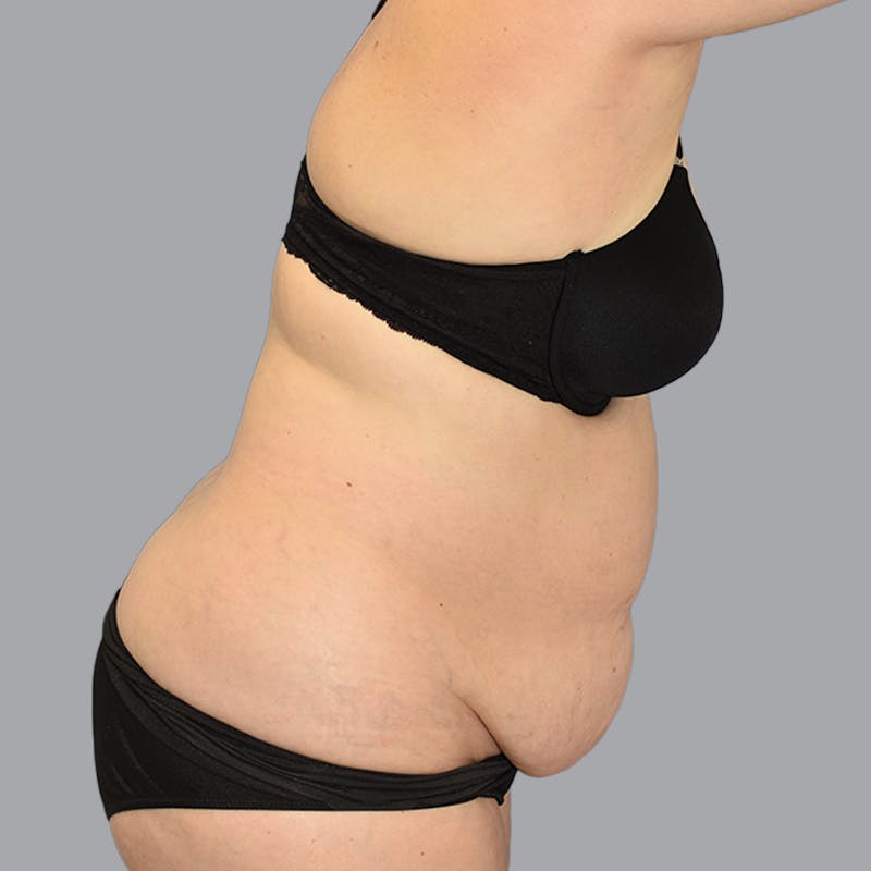 Body Liposuction Before & After Gallery - Patient 246752 - Image 13