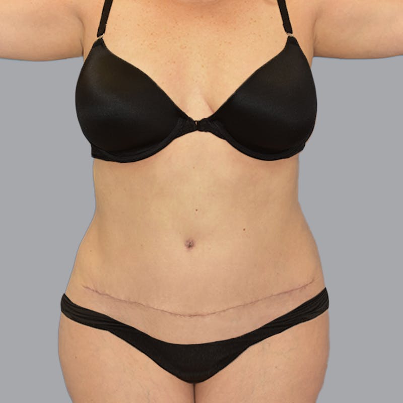 Abdominoplasty Before & After Gallery - Patient 704700 - Image 2