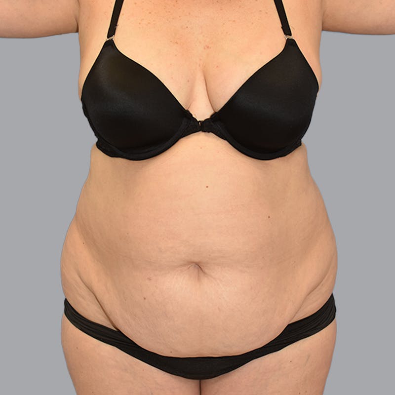 Body Liposuction Before & After Gallery - Patient 246752 - Image 1