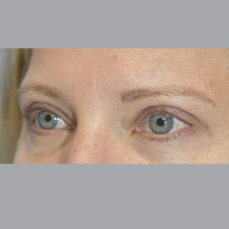 Blepharoplasty Before & After Gallery - Patient 327032 - Image 4