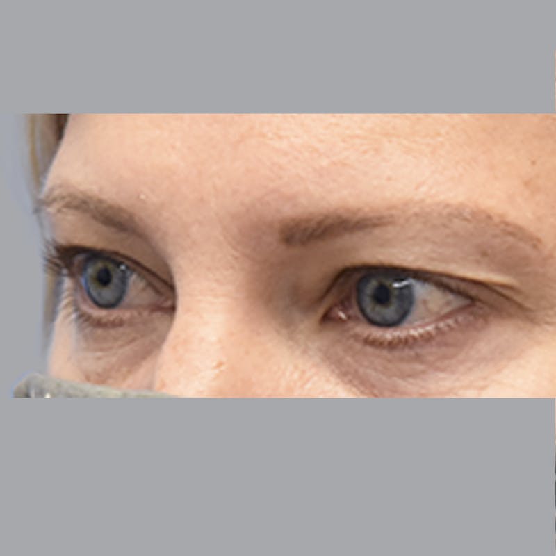 Blepharoplasty Before & After Gallery - Patient 327032 - Image 3