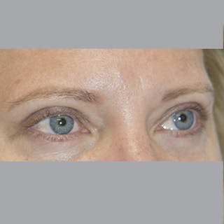 Blepharoplasty in Tampa Before & After Gallery - Patient 327032 - Image 6