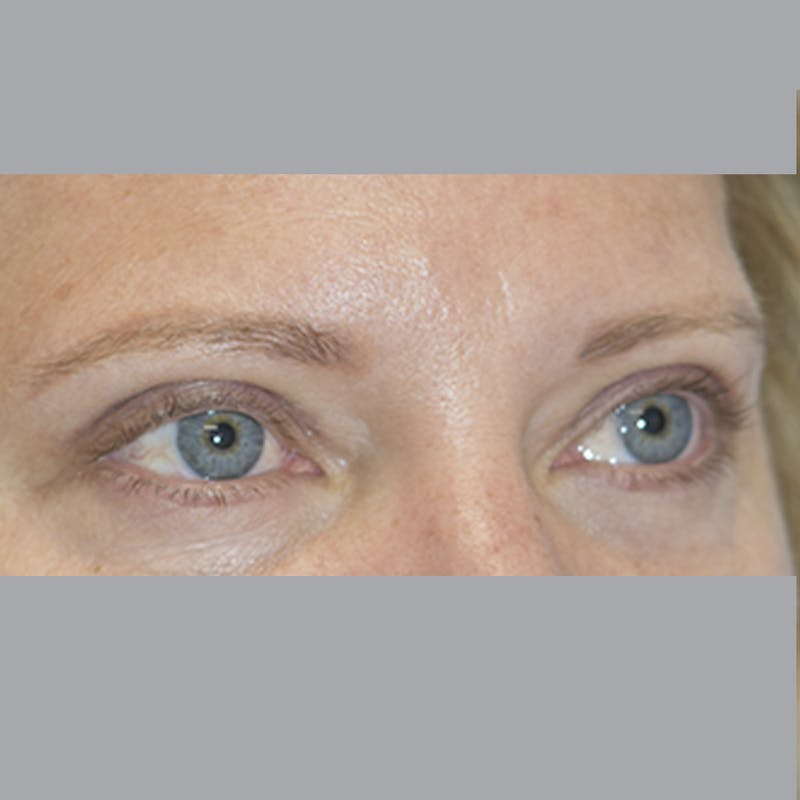 Blepharoplasty Before & After Gallery - Patient 327032 - Image 6