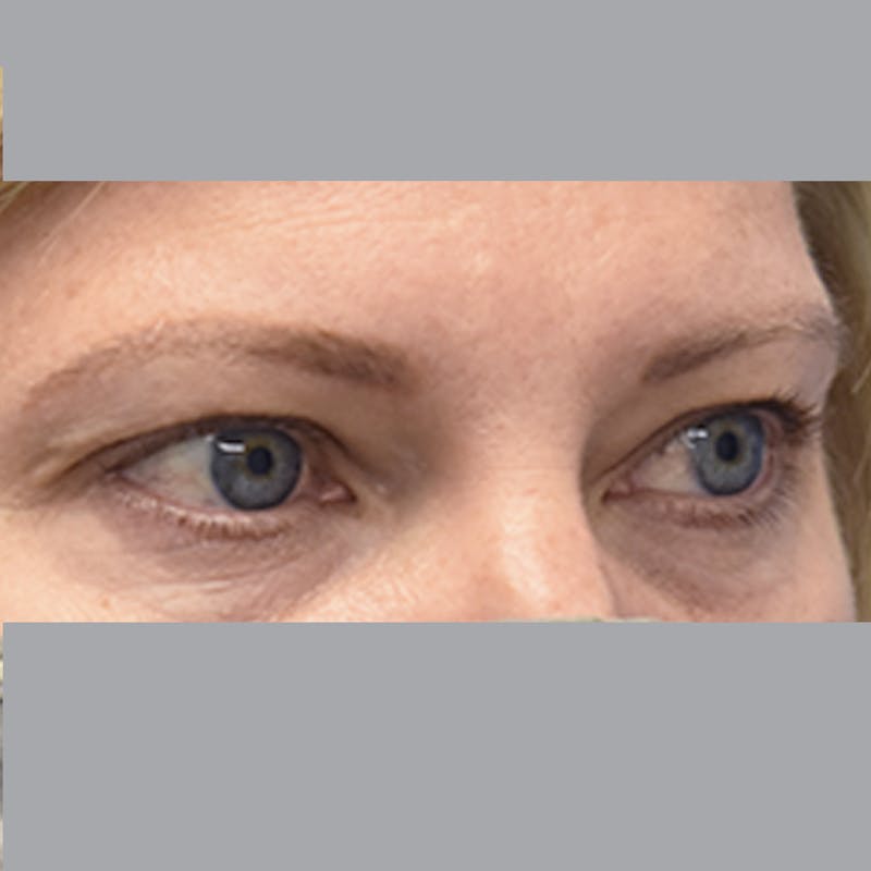 Blepharoplasty Before & After Gallery - Patient 327032 - Image 5