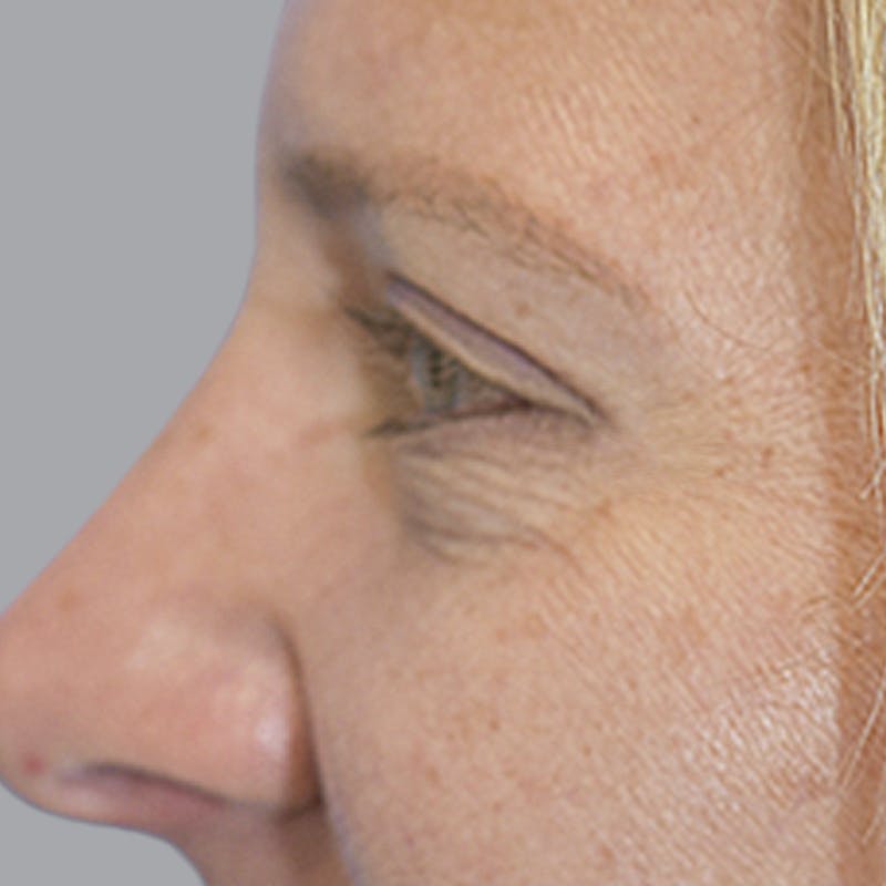 Blepharoplasty Before & After Gallery - Patient 327032 - Image 8
