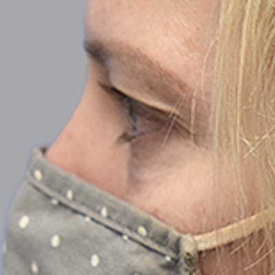 Blepharoplasty Before & After Gallery - Patient 327032 - Image 7