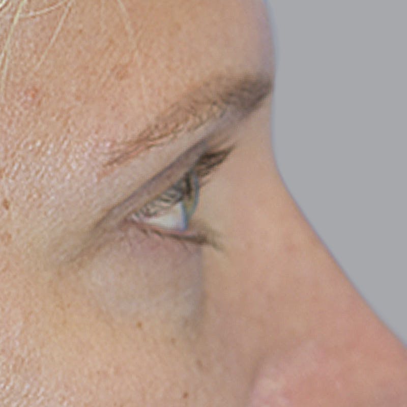 Blepharoplasty Before & After Gallery - Patient 327032 - Image 10