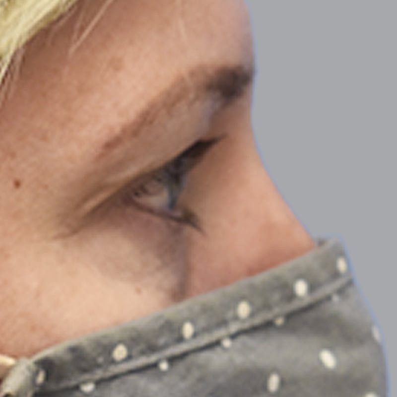 Blepharoplasty Before & After Gallery - Patient 327032 - Image 9