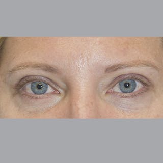 Blepharoplasty in Tampa Before & After Gallery - Patient 327032 - Image 2