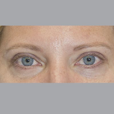 Blepharoplasty Before & After Gallery - Patient 327032 - Image 2