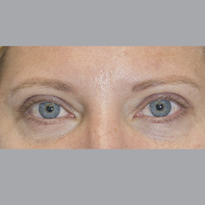 Blepharoplasty Before & After Gallery - Patient 327032 - Image 2