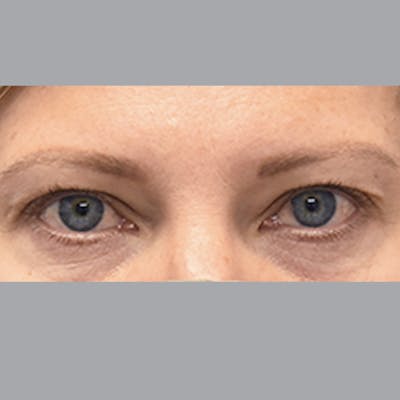 Blepharoplasty Before & After Gallery - Patient 327032 - Image 1