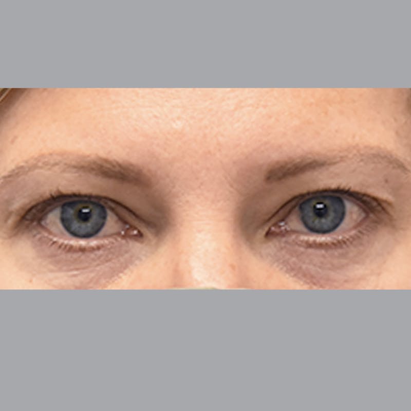Blepharoplasty Before & After Gallery - Patient 327032 - Image 1