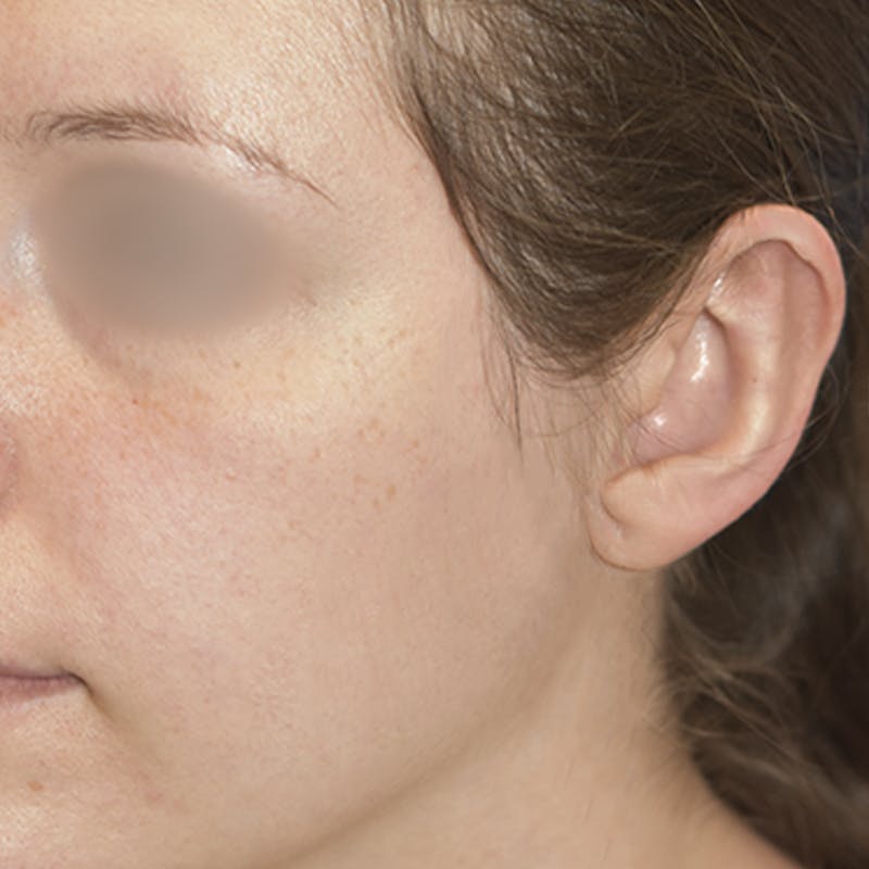 Otoplasty Before & After Gallery - Patient 723881 - Image 6