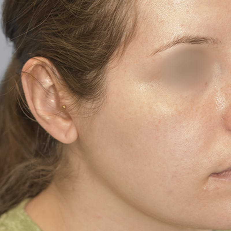 Otoplasty Before & After Gallery - Patient 723881 - Image 8