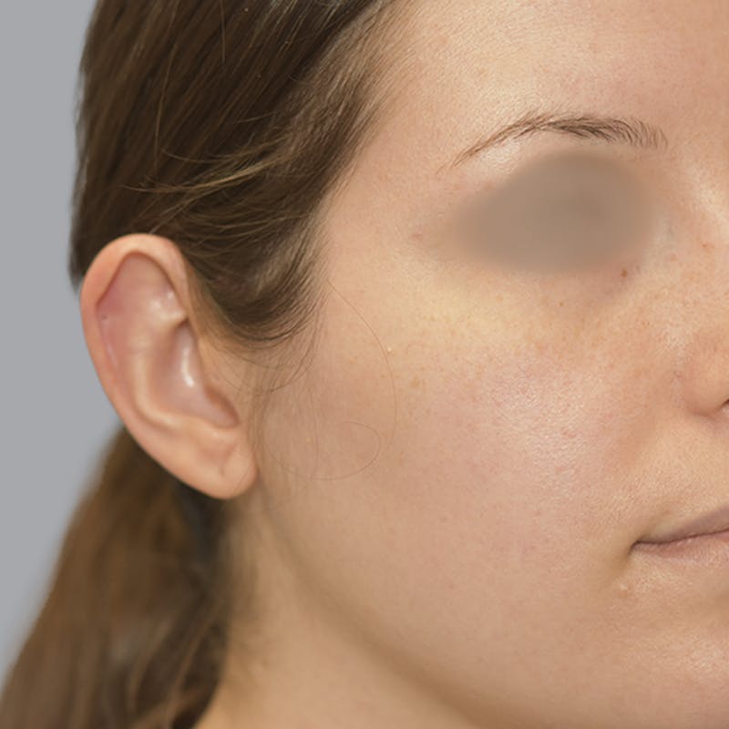Otoplasty Before & After Gallery - Patient 723881 - Image 7