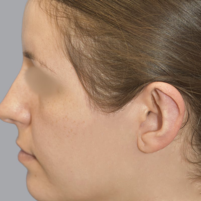 Otoplasty Before & After Gallery - Patient 723881 - Image 10