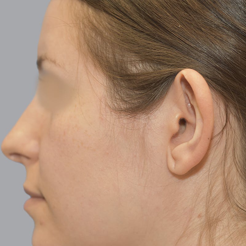 Otoplasty Before & After Gallery - Patient 723881 - Image 9