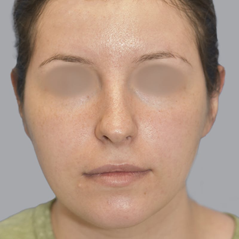 Otoplasty Before & After Gallery - Patient 723881 - Image 2