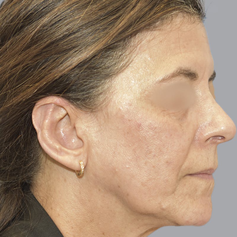 Otoplasty Before & After Gallery - Patient 651701 - Image 8