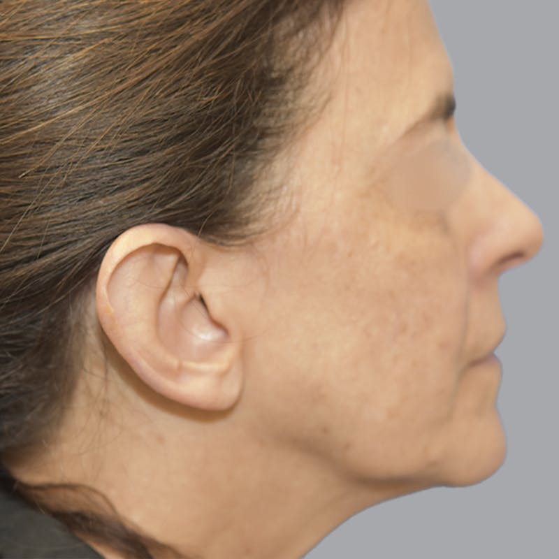 Otoplasty Before & After Gallery - Patient 651701 - Image 7