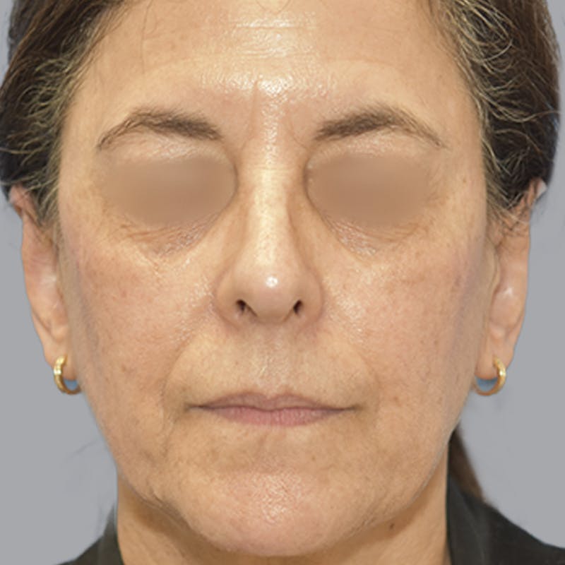 Otoplasty Before & After Gallery - Patient 651701 - Image 2