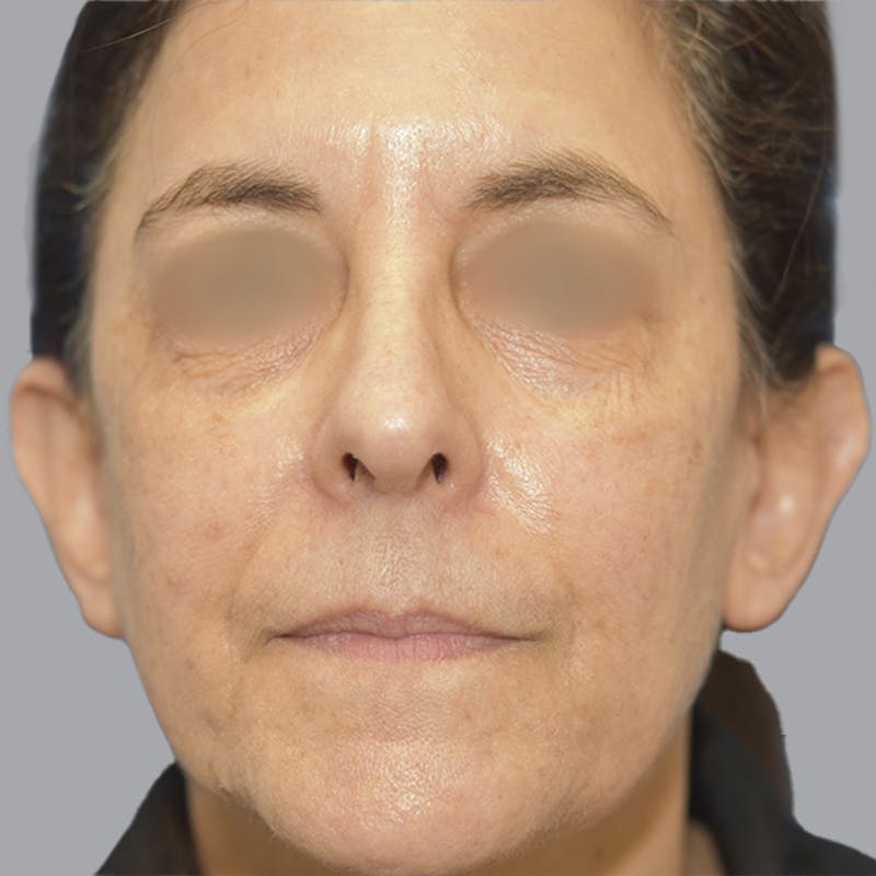 Otoplasty Before & After Gallery - Patient 651701 - Image 1