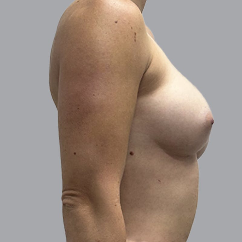 Breast Augmentation with Fat Transfer Before & After Gallery - Patient 349471 - Image 8