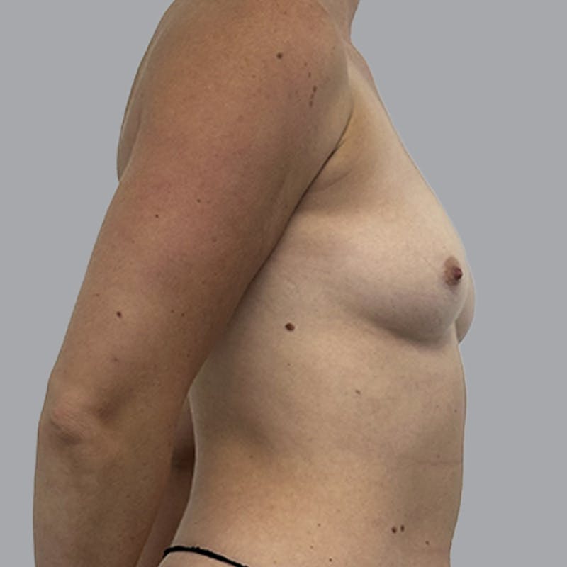 Breast Augmentation with Fat Transfer Before & After Gallery - Patient 349471 - Image 7