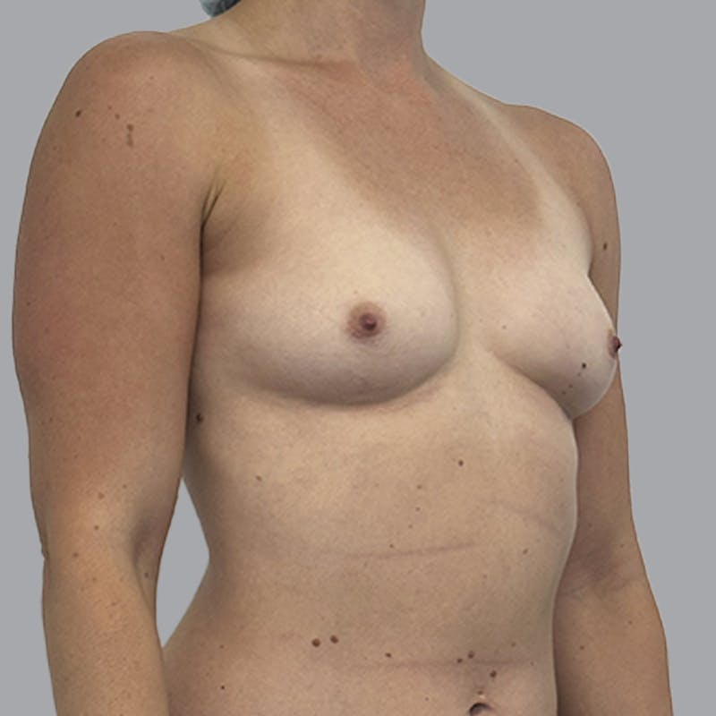 Breast Augmentation with Fat Transfer Before & After Gallery - Patient 349471 - Image 3