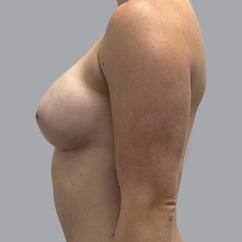 Breast Augmentation with Fat Transfer Before & After Gallery - Patient 349471 - Image 10