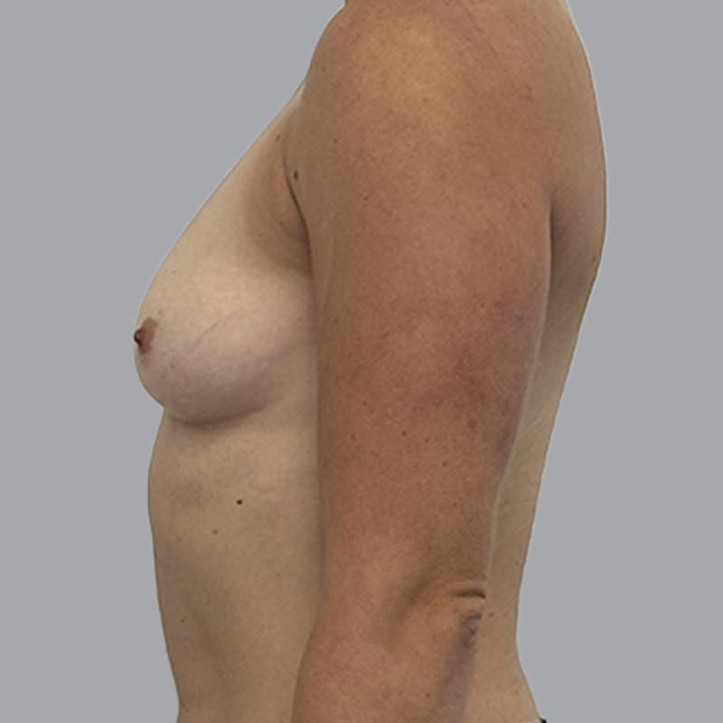 Breast Augmentation with Fat Transfer Before & After Gallery - Patient 349471 - Image 9