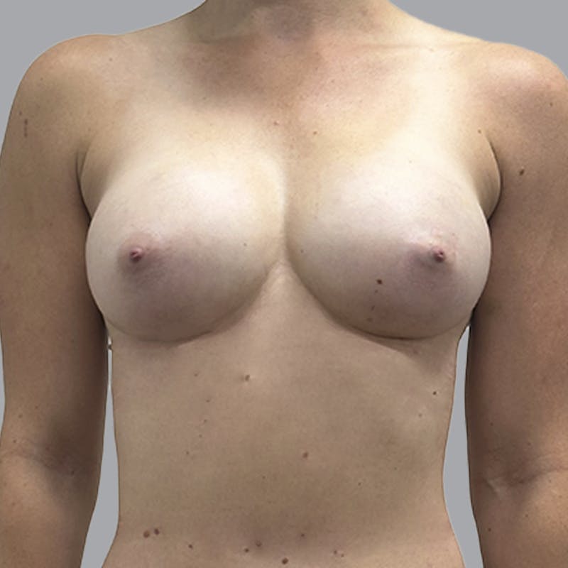 Breast Augmentation with Fat Transfer Before & After Gallery - Patient 349471 - Image 2