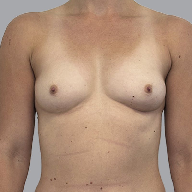 Breast Augmentation with Fat Transfer Before & After Gallery - Patient 349471 - Image 1