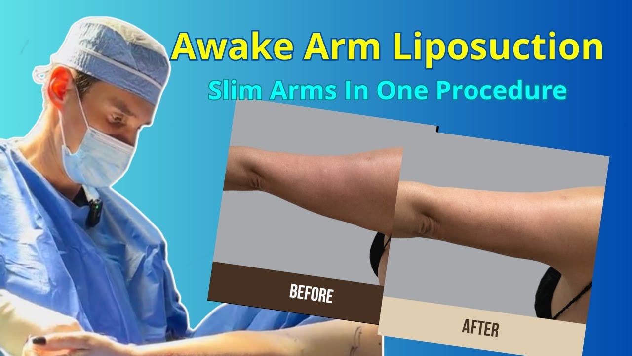 Liposuction of the Arms | AM Plastic Surgery